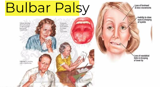 Bulbar Palsy নিয়ে আজকের আলোচনা ! - MediVerse