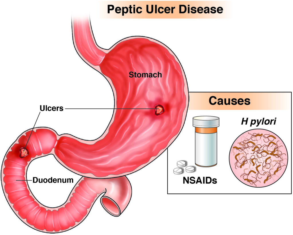 Relation Between PUD And NSAIDs