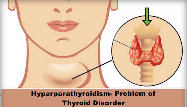 Hyperparathyroidism নিয়ে কিছু কথা !