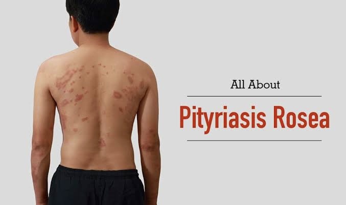 All About Pityriasis Rosea !!!