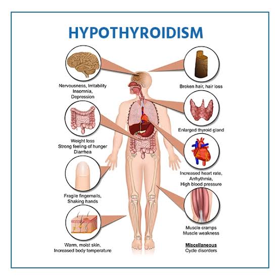 Hypothyroidism কি ? কেন হয়? কি করবেন ?