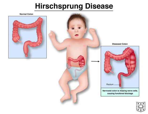 Hirschsprung Disease : একটি জন্মগত রোগ।