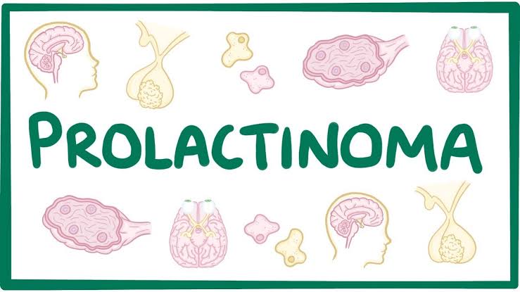 আজকের গল্প Prolactinoma নিয়ে !!