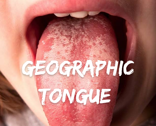 Geographic tongue এর চিকিৎসা !!