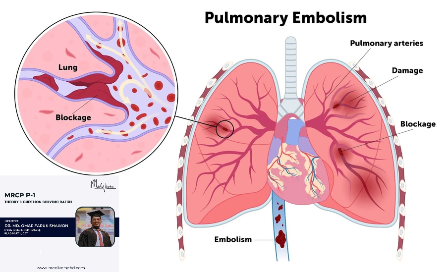 Approach to a patient with symptoms suggestive of Pulmonary embolism.