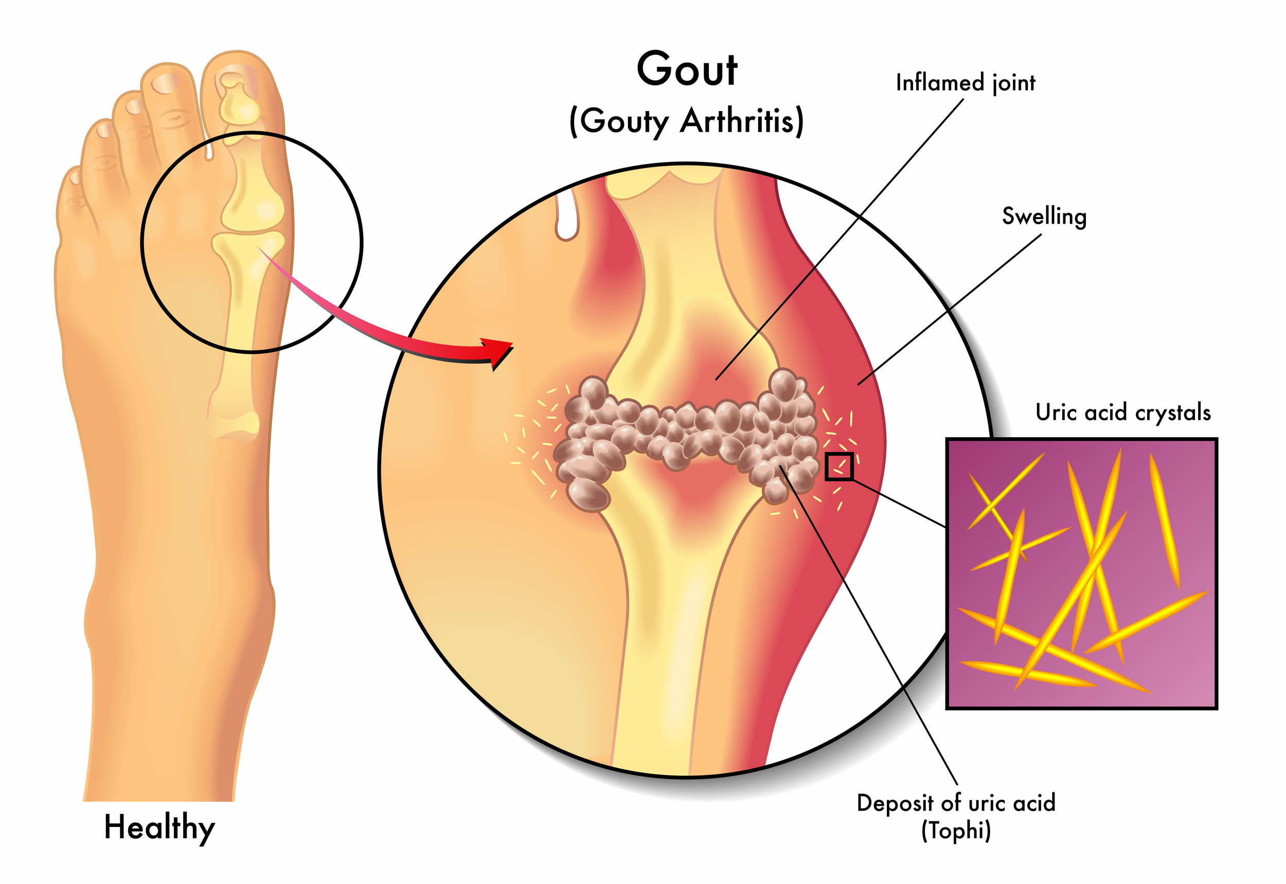 Gout এ কয় ধরণের ঔষধ পাওয়া যায় ?
