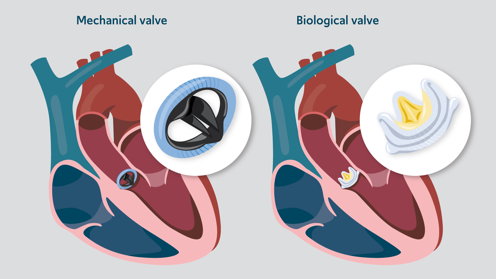 Topic About Valve Replacement !!
