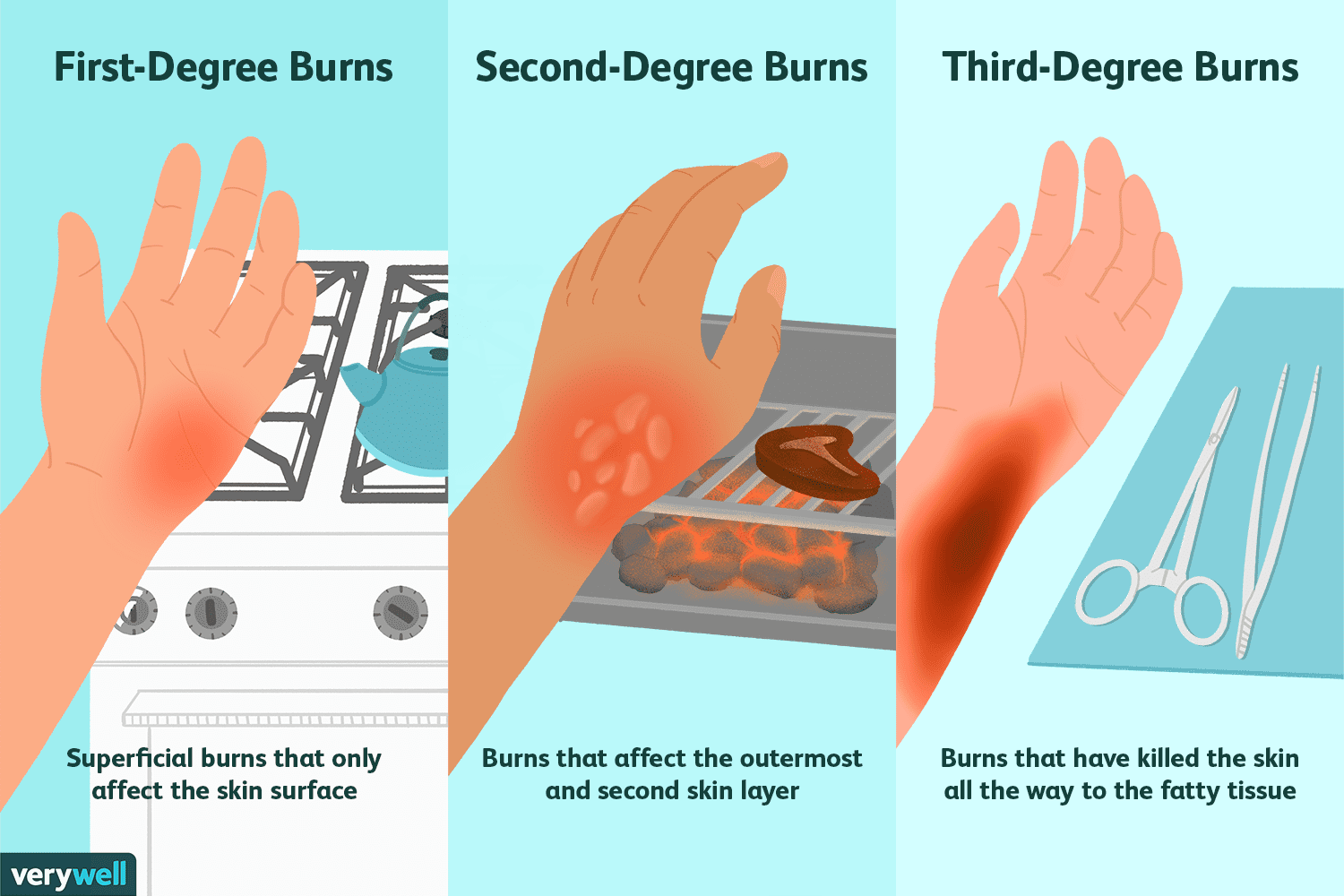 Learn About Fluid Management of Burn !!
