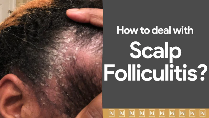 Scalp folliculitis এর Treatment !!