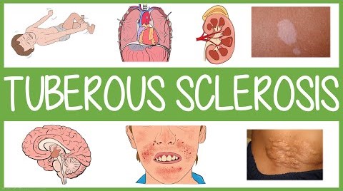 A Case About Tuberous Sclerosis !!