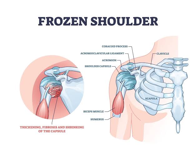 Frozen Shoulder নিয়ে কথা !