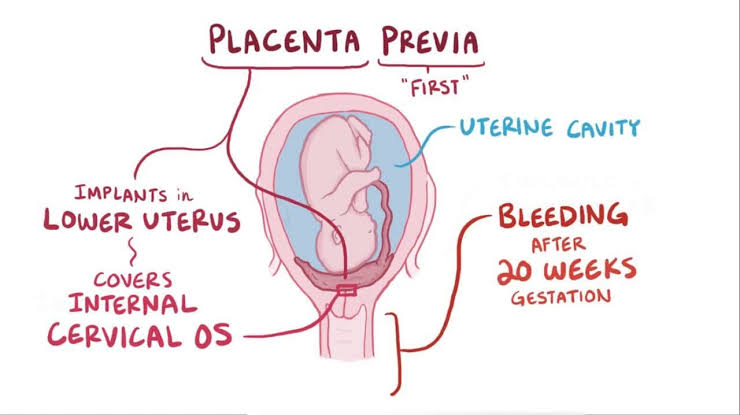 Types Of Placenta Previa..
