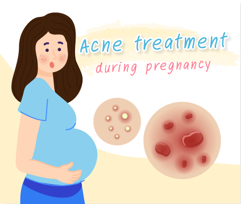 Acne Management In Pregnancy !!