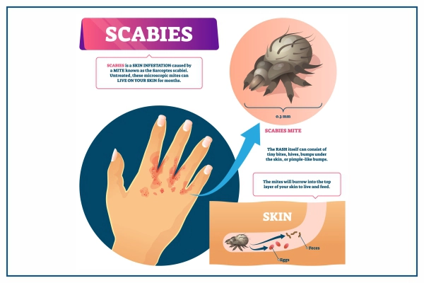 Treatment Of Scabies !!