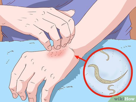 Pinworm Infection এর চিকিৎসা !!