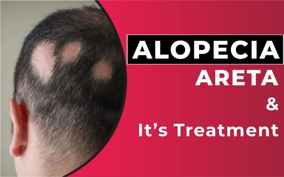 Alopecia areata কি?