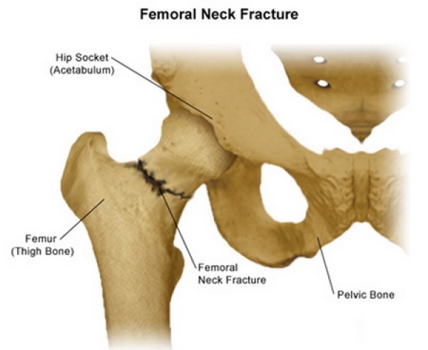 This image has an empty alt attribute; its file name is hipfracture-diagram-femoralneck.jpg