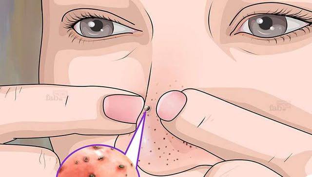 Blackhead এর চিকিৎসা !!!