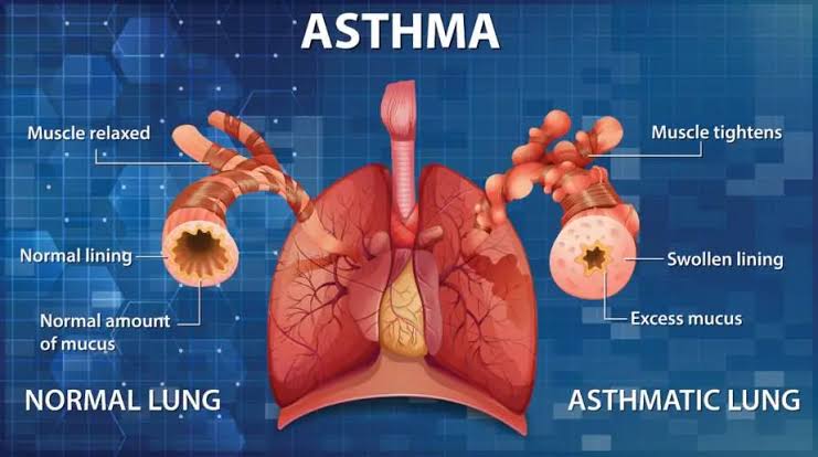 Story Of Asthma !!