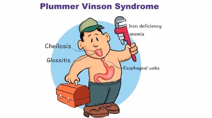 Plummer Vinson Syndrome এর গল্প !!