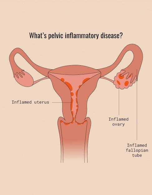 Information About Pelvic Inflammatory Disease (PID)