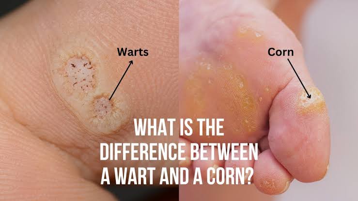 What is corns and callus &amp; Difference With Wart !