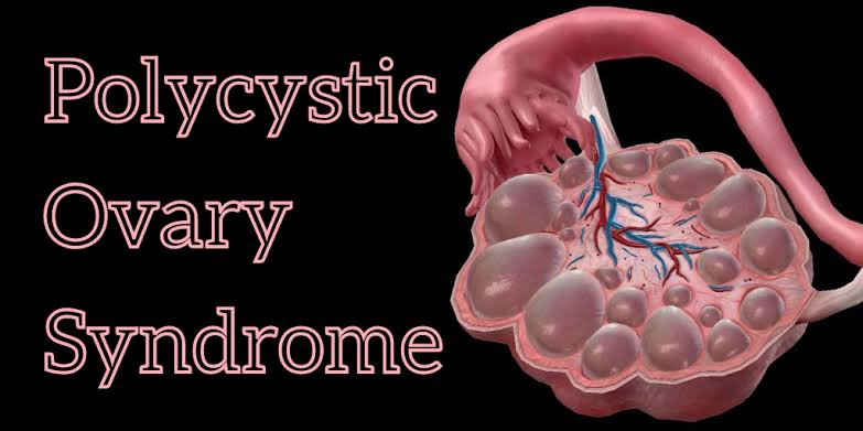 Polycystic ovary তে Life style Modification কী হবে !!