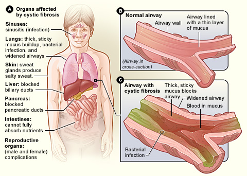 Complications Of cystic fibrosis !!