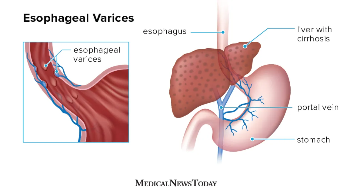 Management of ruptured esophageal variceal bleeding !!