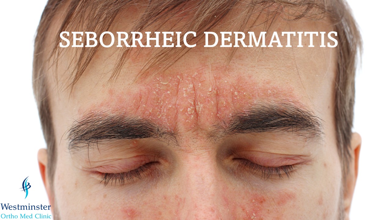 Seborrheic Dermatitis (SD)/ খুশকী/ Dandruff এর সমাধান কী !!