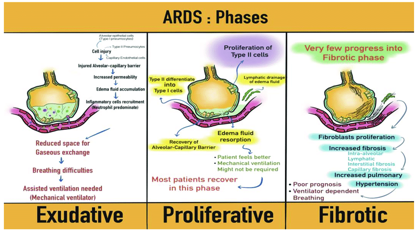 Phases Of ARDS !!