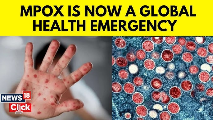 A Quick Overview About MPOX !!!