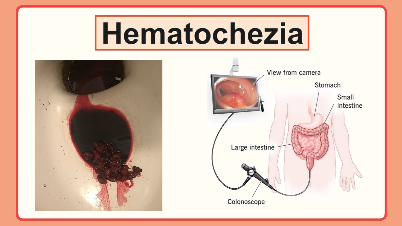 Hematochezia এর কারন কী ?!