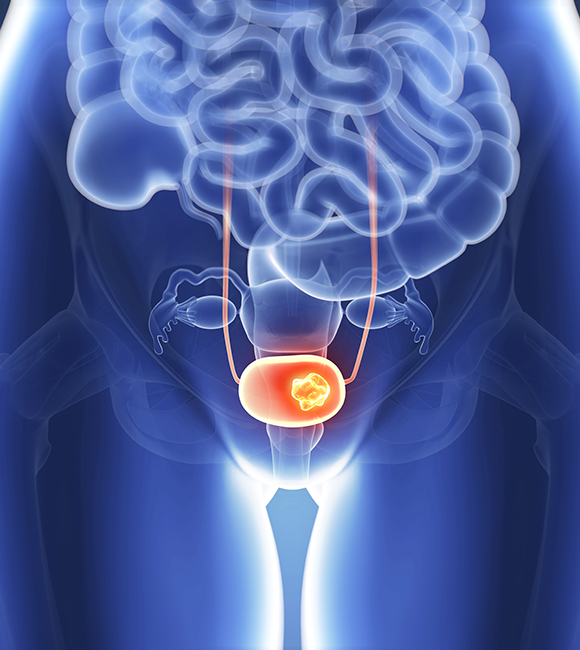 Prevention of Urinary Tract Infection (UTI) in Neurogenic Bladder (NGB)